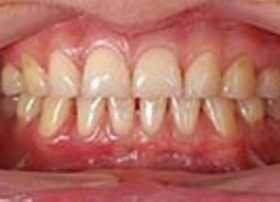 علائم عفونت لثه علائم عفونت لثه